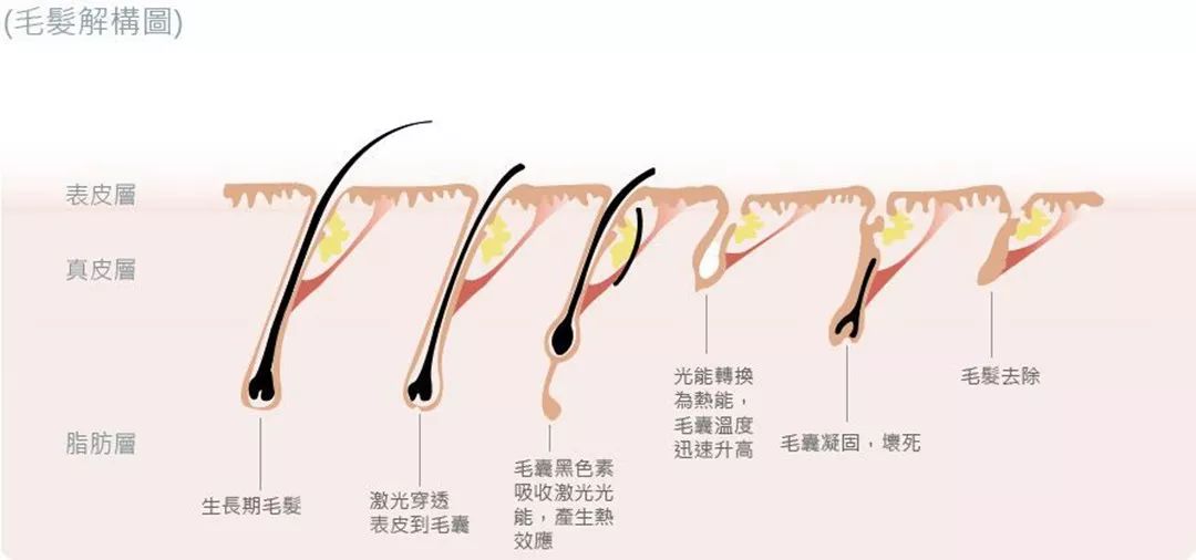 “白煮蛋”与“猕猴桃”之间，还差一个它 强脉冲脱毛器械，值得买吗？